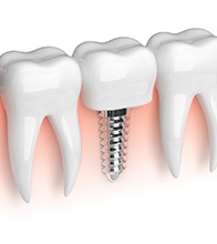 Diagram of an integrated dental implant in Blaine