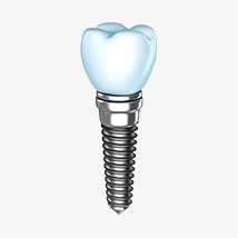 illustration of implant