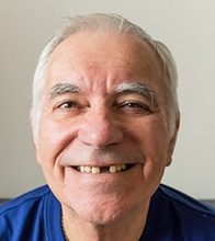 Blaine patient showing gaps from missing teeth 