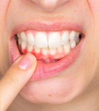 Woman holding down lip showing symptoms of gum disease in Blain, MN