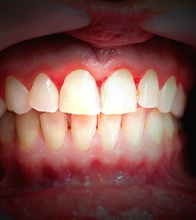 Image of mouth with advanced gum disease in Blain, MN