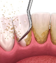Illustration of scaling and root planing to treat gum disease in Blaine, MN