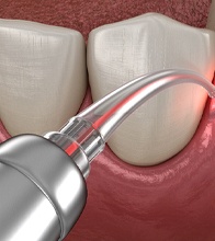 Soft tissue laser being used to treat gum disease in Blain, MN