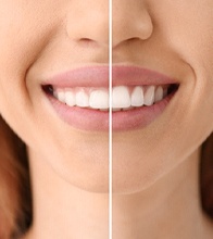 A side-by-side image of a person who underwent gummy smile correction in Blaine