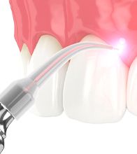 A digital image of a dental laser preparing to remove excess gum tissue in Blaine