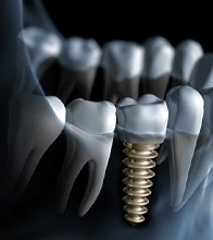 Digital illustration of a dental implant