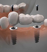 Digital illustration of an implant bridge