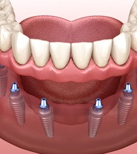 Digital illustration of an implant denture