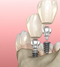 Digital illustration of mini dental implants