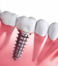 Diagram of an integrated dental implant in Blaine