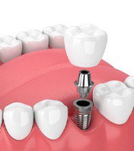 Diagram of the components of a dental implant in Blaine