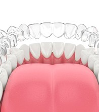 Illustration of clear aligner being placed on teeth in lower arch