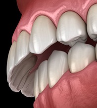 Illustration of an overbite against a dark background