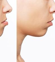 Patient’s side profile before and after correcting an underbite