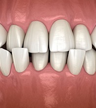 Close-up illustration of a crossbite