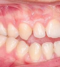 Close-up photo of an open bite