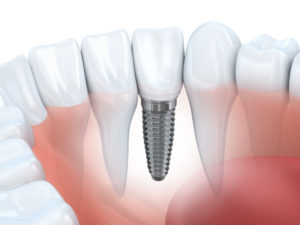 dental implants blaine