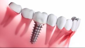 Model of an implant in a lower jaw