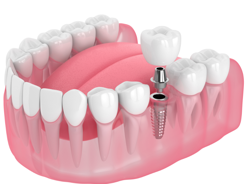 Dental implant