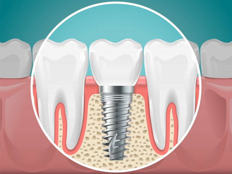 close-up illustration of dental implant